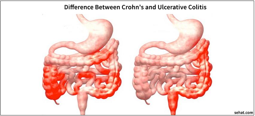 Difference Between Crohn's and Ulcerative Colitis