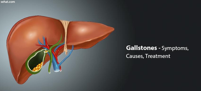 Gallstones Risk Factors, Symptoms, Causes, Treatment