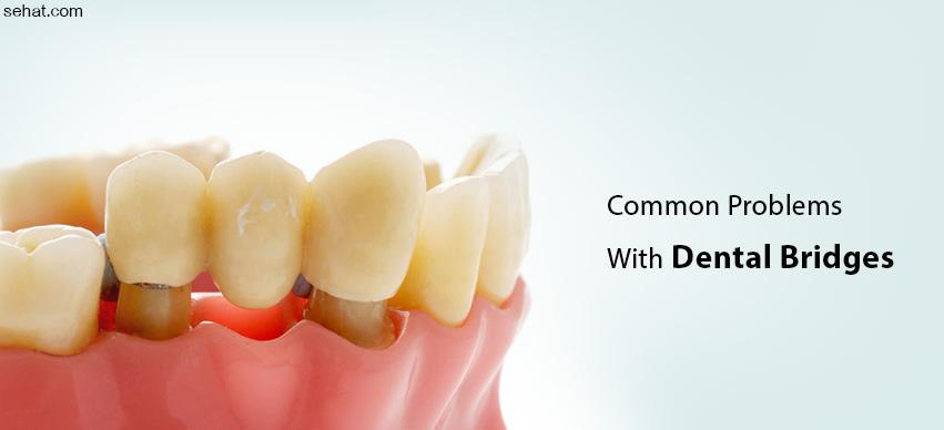 common problems with dental bridges