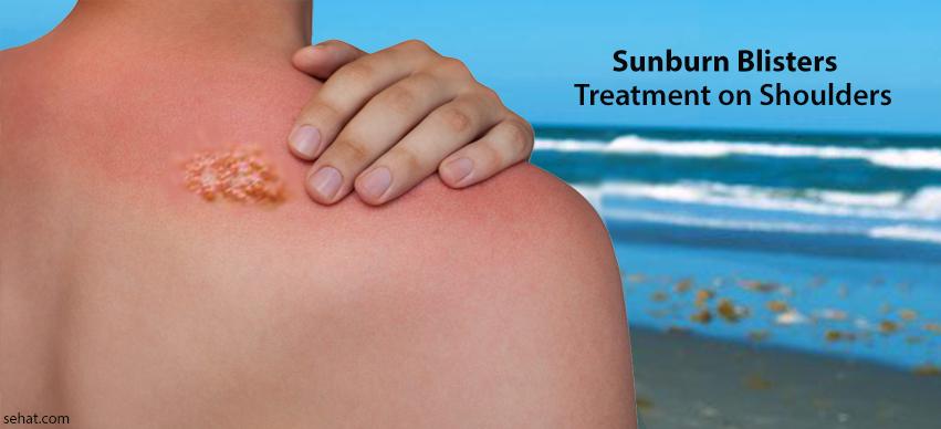 sunburn blisters treatment on shoulders