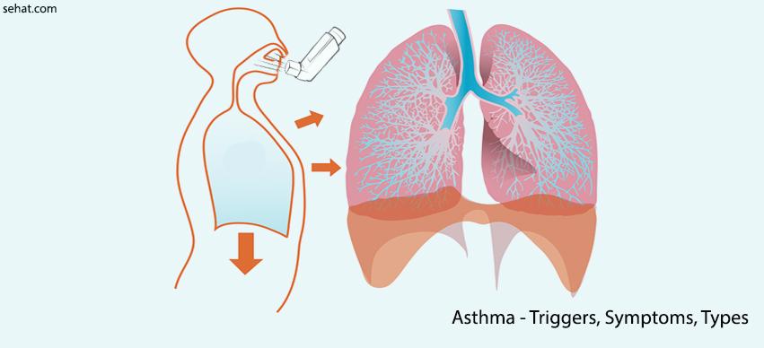 Asthma triggers list,symptoms,types