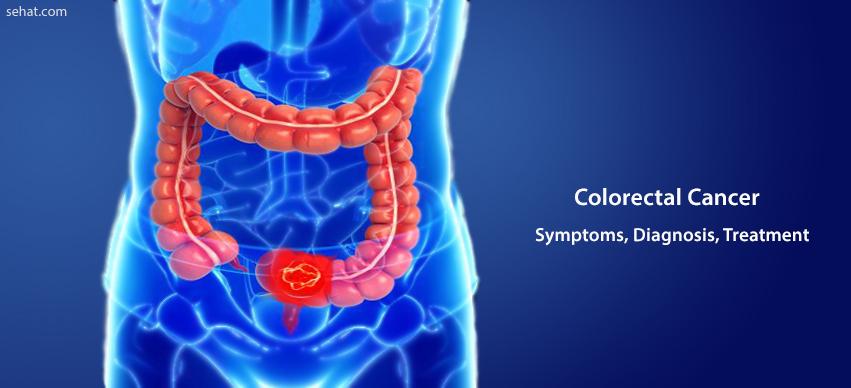(Colorectal) Colon Cancer - Symptoms, Treatment, Diagnosis