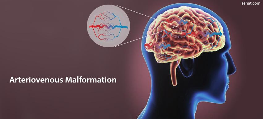 Arteriovenous malformation in Abroad - Cost and Benefits