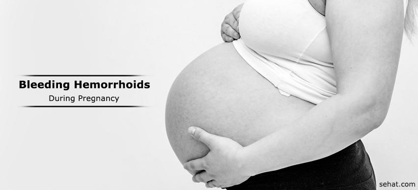 Bleeding Hemorrhoids During Pregnancy