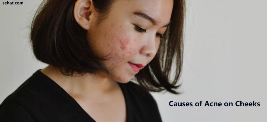 Causes Of Acne On Cheeks