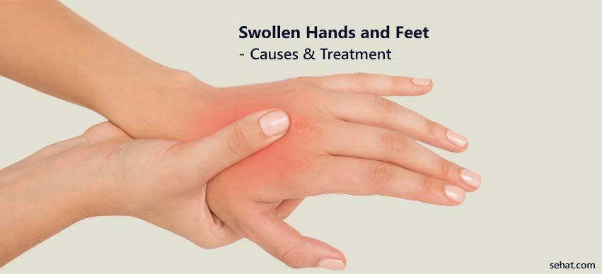 Swollen Hands And Feet - Causes And Treatment