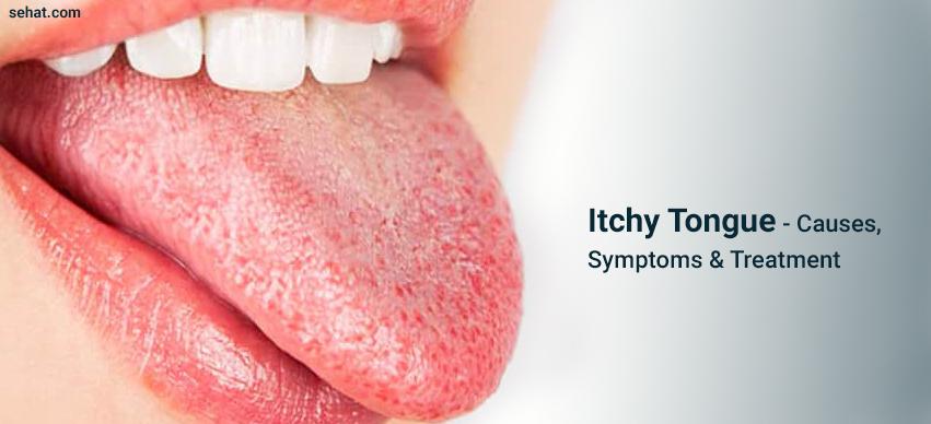 Itchy Tongue - Causes, Symptoms And Treatment