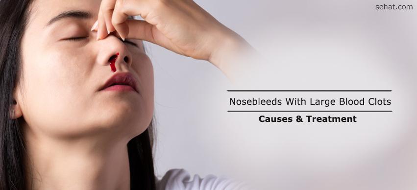 Nosebleeds With Large Blood Clots - Causes And Treatment