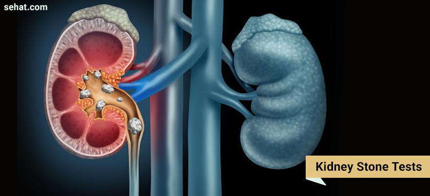 Kidney Stone Tests