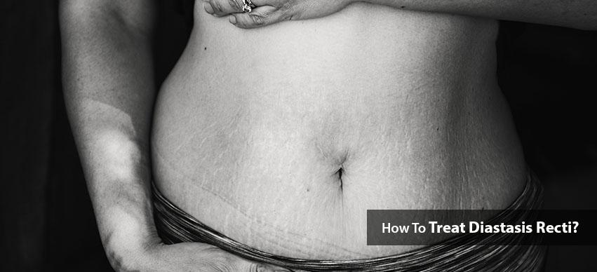 How To Treat Diastasis Recti