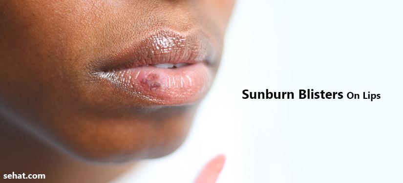 Sunburn Blisters On Lips