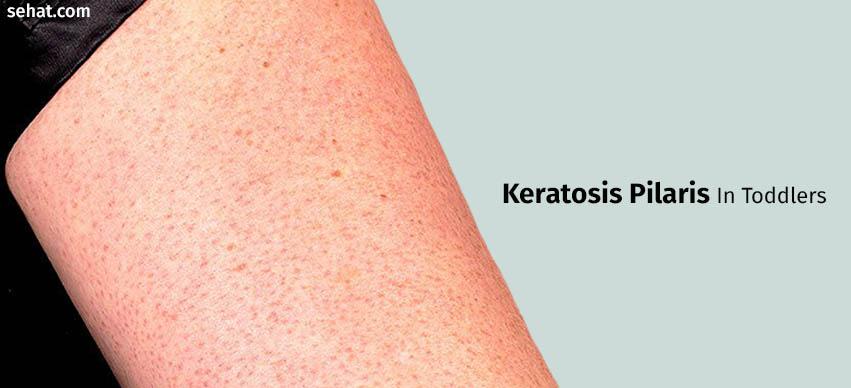 Keratosis Pilaris In Toddlers