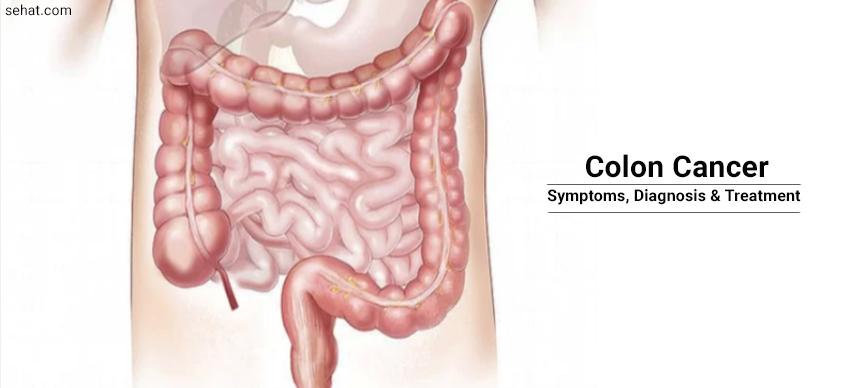 Colon cancer- Symptoms, Diagnosis, And Treatment