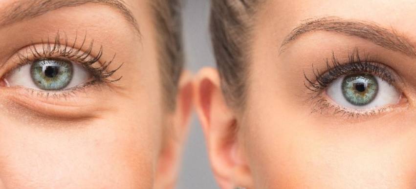 What is the Best Eye Swelling Treatment?