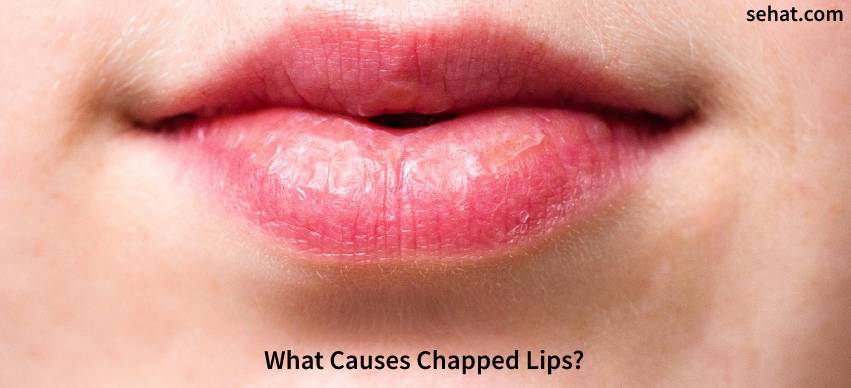 What Causes Chapped Lips?