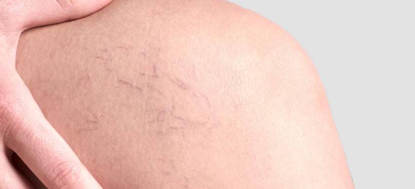 Understanding the Pain and Discomfort of Varicose Veins and How to Manage Them