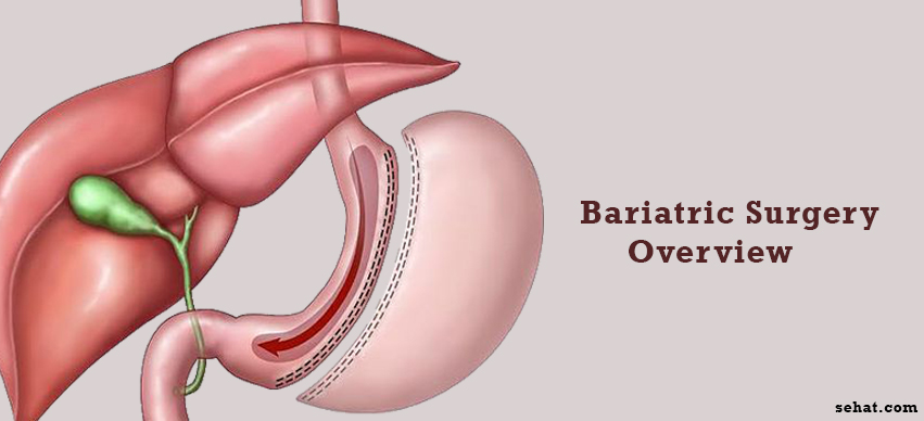 All about the Bariatric Surgery Procedure
