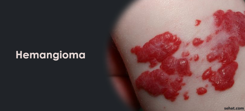  know about Hemangioma Signs and Symptoms