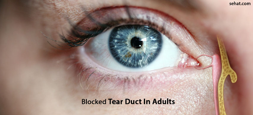 Blocked Tear Duct In Adults- Causes, Symptoms, And Risks