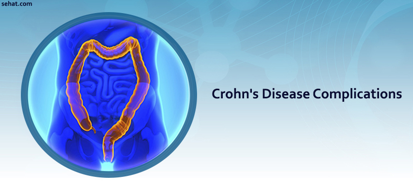 Crohn's Disease Complications if left Untreated