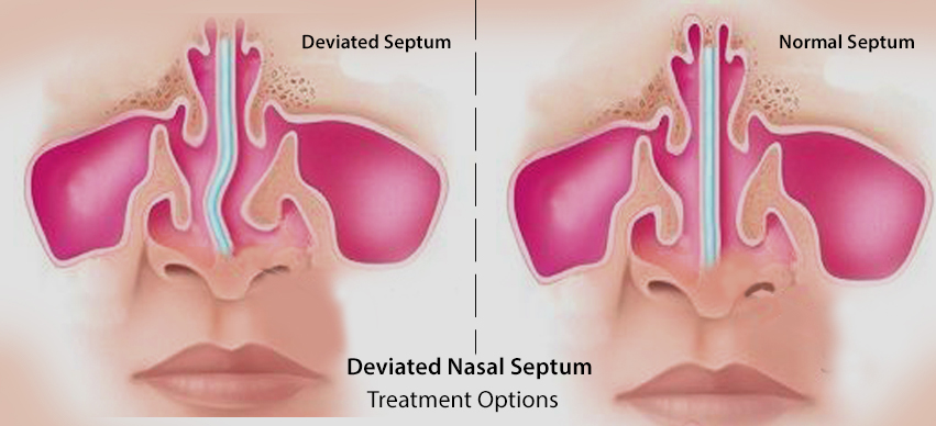 Deviated Nasal Septum Treatment Options