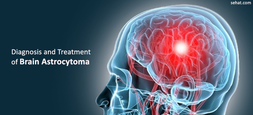 Diagnosis And Treatment Of Brain Astrocytoma In German Hospitals
