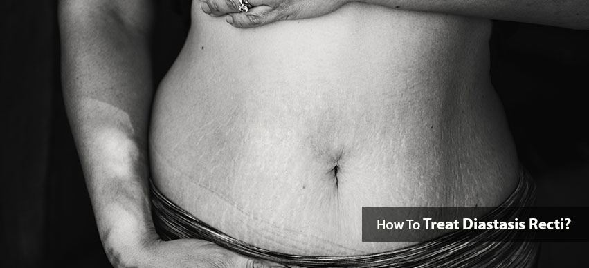 Diastasis Recti- Do You Have It? Plus How To Treat It