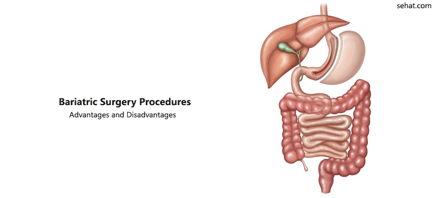 Different Types Of Bariatric Surgery Procedures- Advantages And Disadvantages