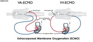 Extracorporeal Membrane Oxygenation (ECMO)