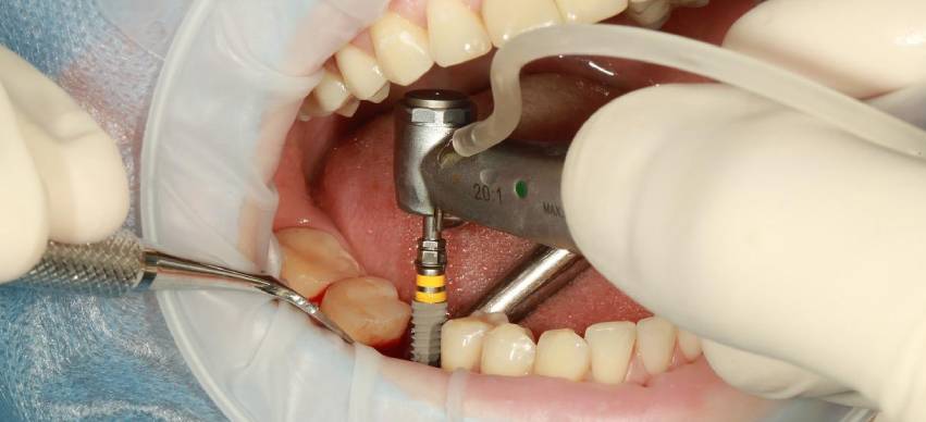 Facts to Consider About Dental Implant Procedures
