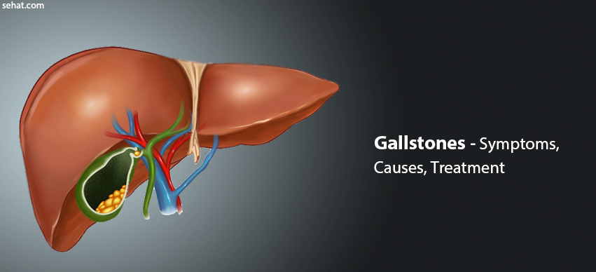 Gallstones Risk Factors, Causes, Symptoms, Treatment, Prevention