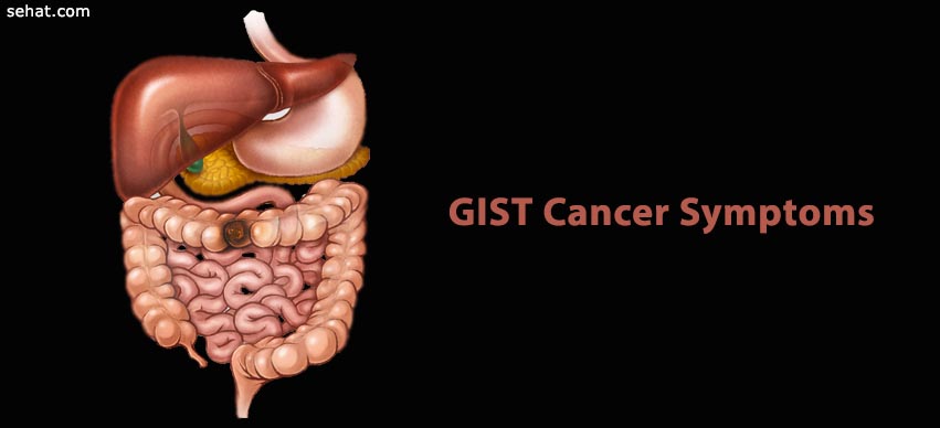 GIST Cancer Symptoms