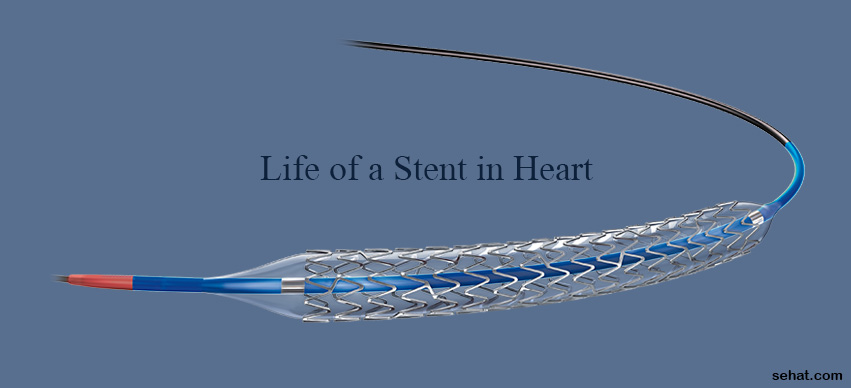 How Long Does a Heart Stent Last?