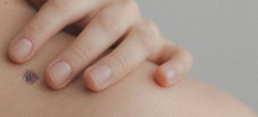 How To Come To Terms With A Melanoma Diagnosis