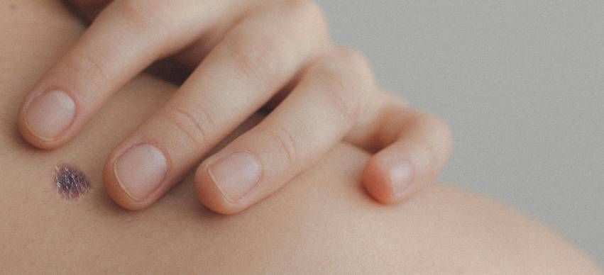 How To Come To Terms With A Melanoma Diagnosis