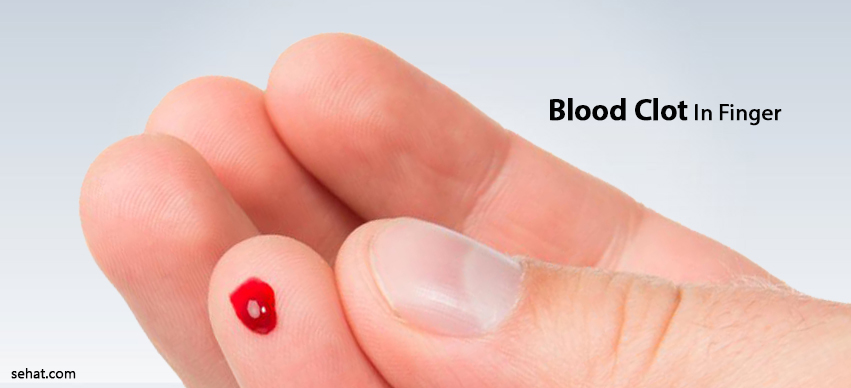 How To Get Rid Of Blood Clot In Finger
