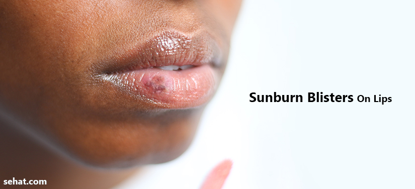 How To Get Rid Of Sunburn Blisters On Lips?