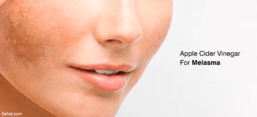 How To Use Apple Cider Vinegar For Melasma?