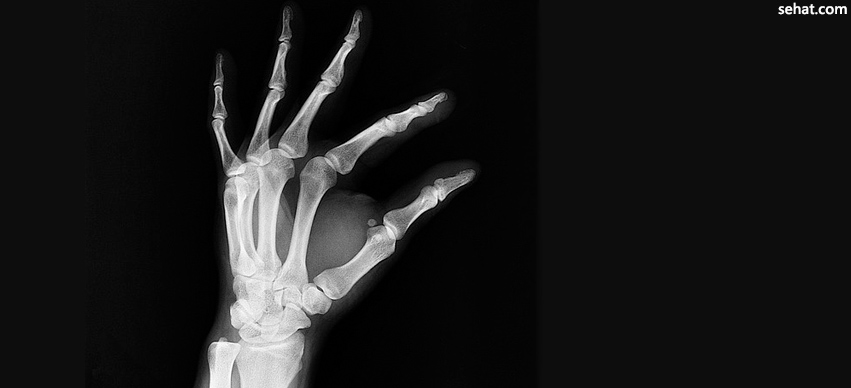 Improving Bone Health to Reduce the Risk of Fracture