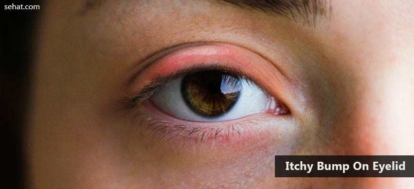 Know The Causes And Prevention Tips For Itchy Bump On Eyelid