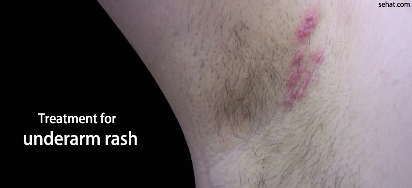 Natural Remedies to Treat Armpit Rash Quickly