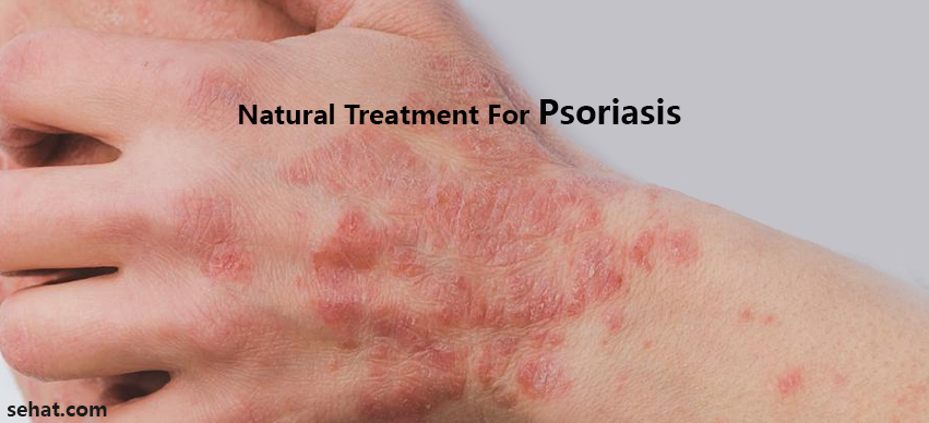 Natural Treatment And Home Remedies For Psoriasis