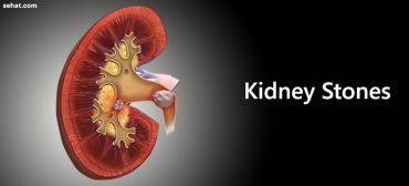 Oh! Those Troublesome Kidney Stones