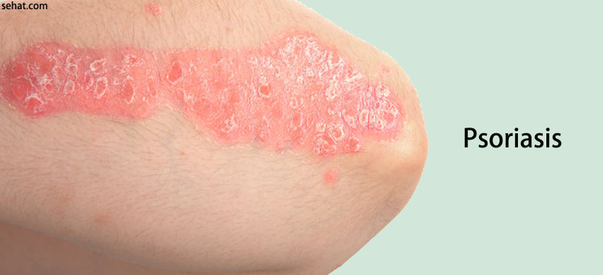 Psoriasis - What You Need to Know