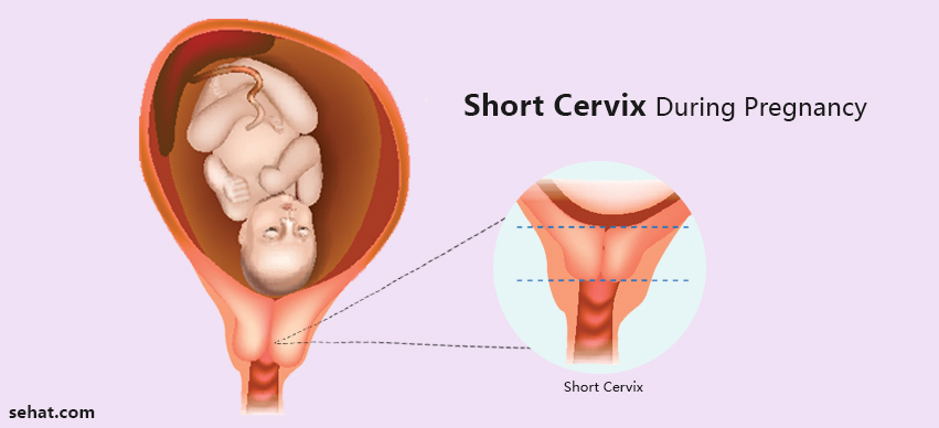 Short Cervix During Pregnancy- Causes, Diagnosis And Treatment