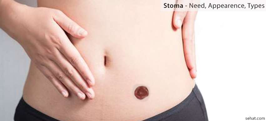 Stoma - Need, Appearance, Types
