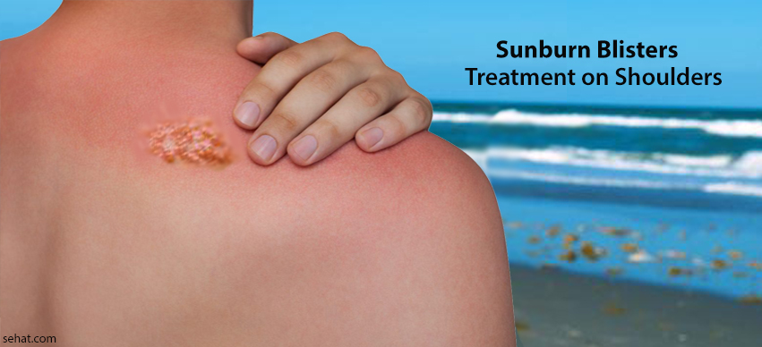 Sunburn Blisters Treatment on Shoulders