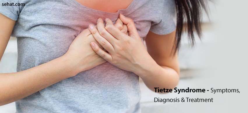 Tietze Syndrome - Pictures, Symptoms, Diagnosis & Treatment