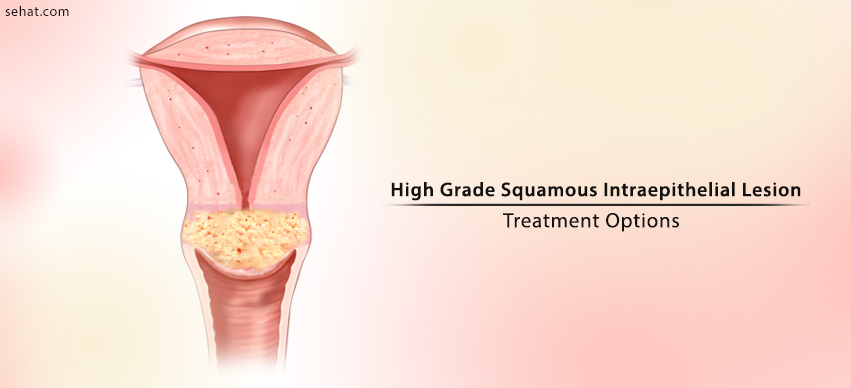 Treatment Options For High Grade Squamous Intraepithelial Lesion