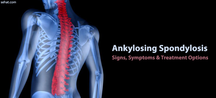 Understanding Ankylosing Spondylosis